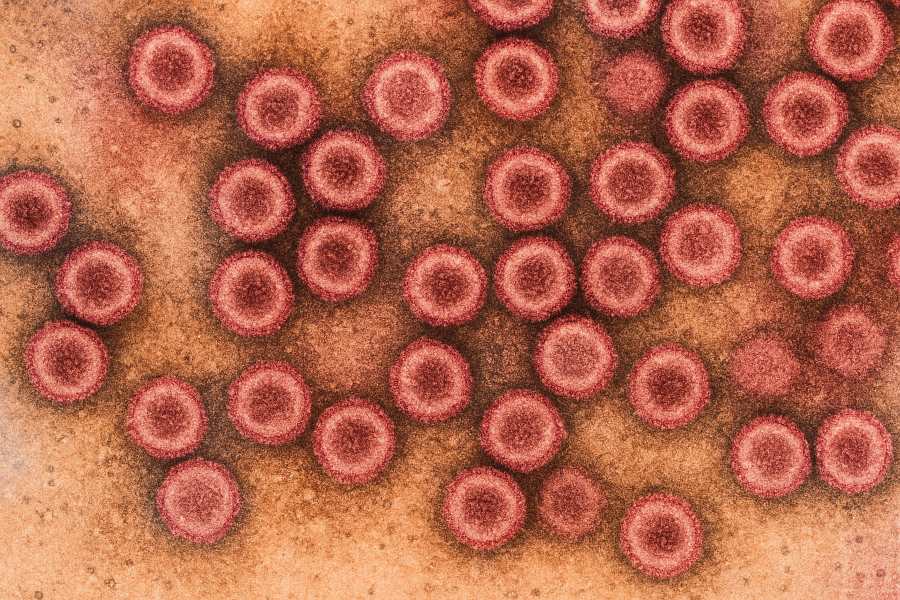 Citomegalovirus relacionado en el Síndrome de Fatiga Crónica