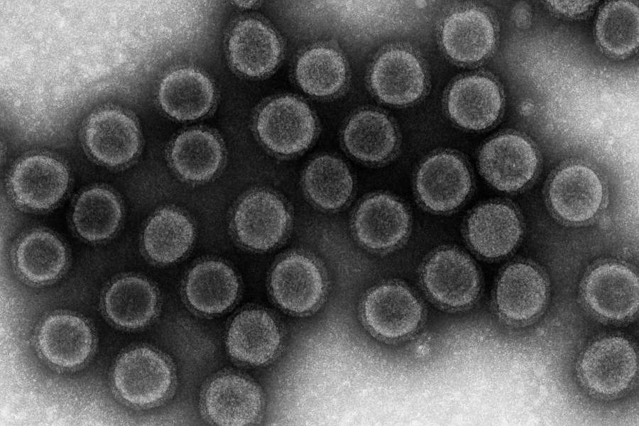 Epstein Barr Virus (EBV) y su relación con el Síndrome de Fatiga Crónica